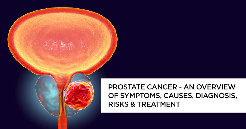 Prostate Cancer – An Overview of Symptoms, Causes, Diagnosis, Risks & Treatment Prostate Cancer – An Overview of Symptoms, Causes, Diagnosis, Risks & Treatment