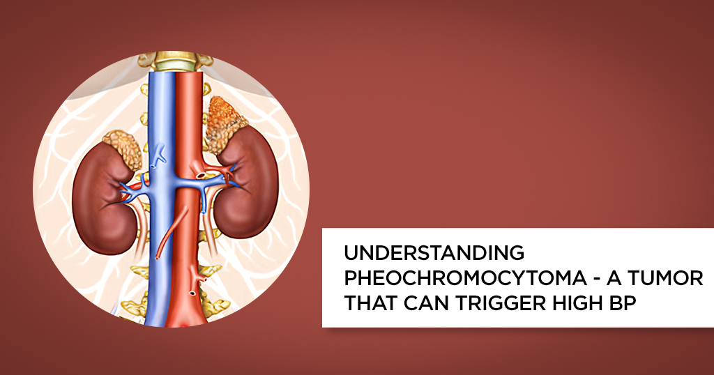 Understanding Pheochromocytoma &#8211; A Tumor that can Trigger High BP