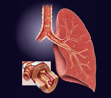 Chronic Bronchitis and COPD &#8211; Causes, Signs and Treatment
