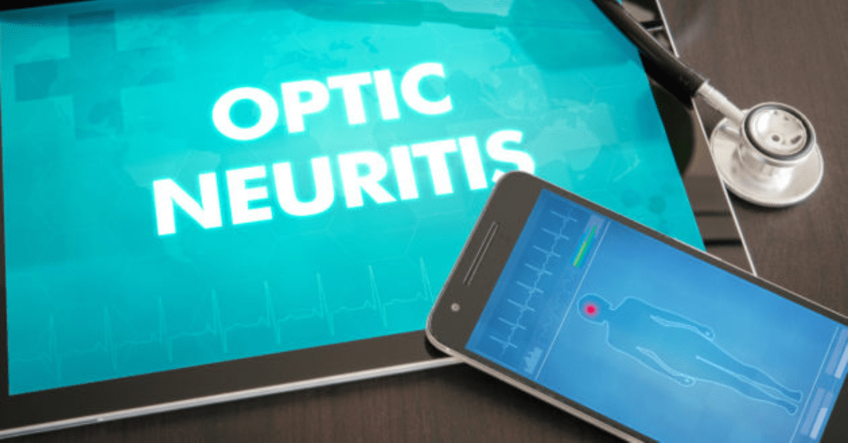 Optic Neuritis &#8211; Causes, Symptoms and Treatment