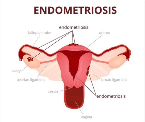 Endometriosis: Causes, Symptoms, Types, Treatment & Risk Factors Endometriosis: Causes, Symptoms, Types, Treatment & Risk Factors
