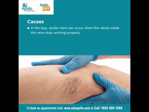 What are Spider Veins &#038; It&#8217;s Symptoms? | Apollo Hospitals