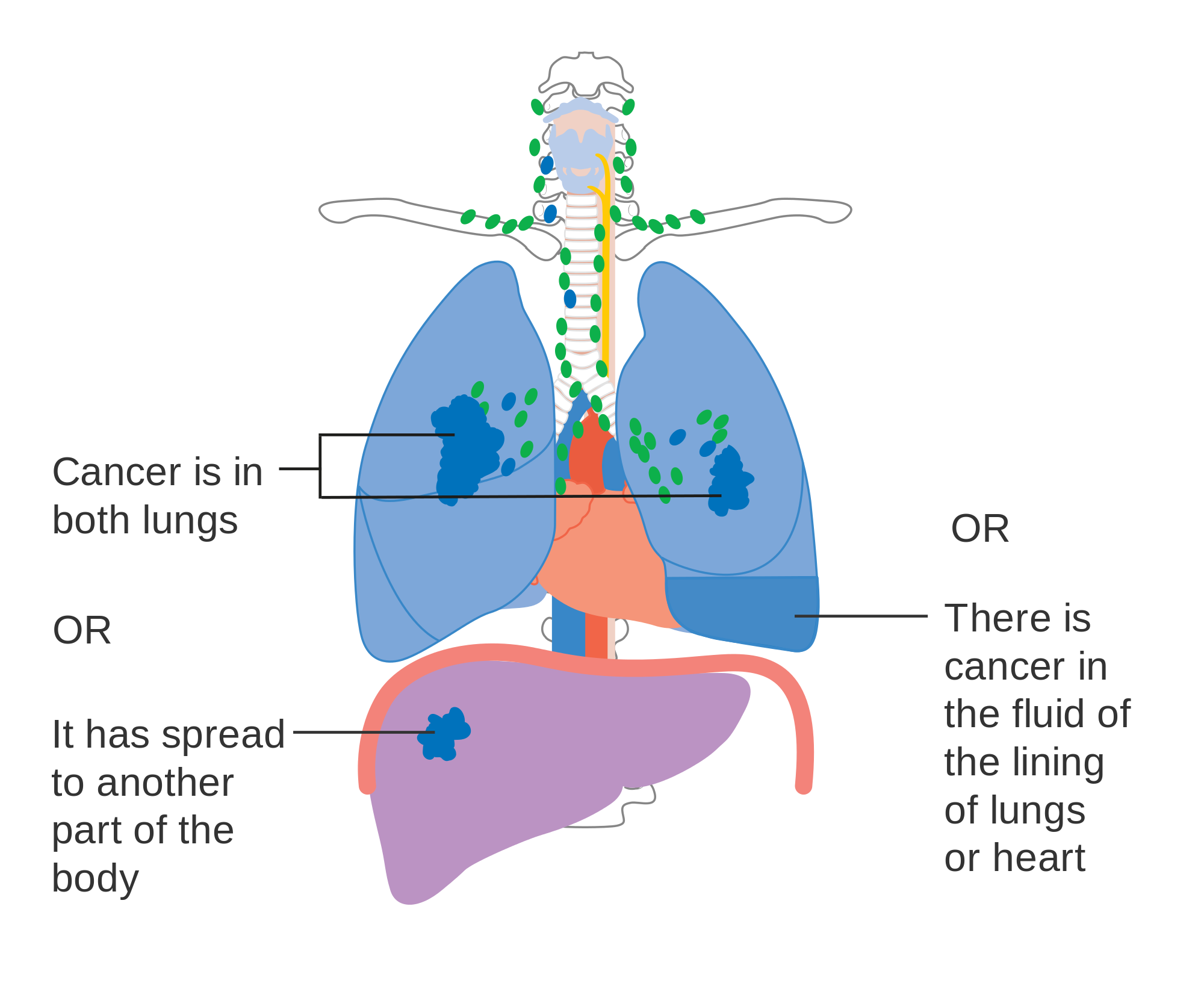 Robotic Heart Surgery Robotic Heart Surgery