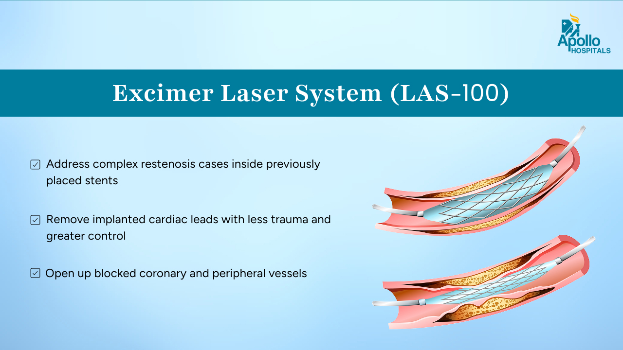 Excimer Laser System