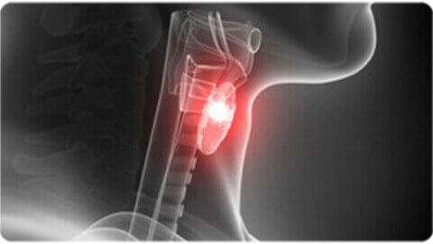 apollo-thyroid-cancer