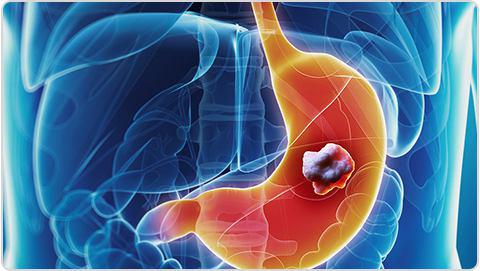 diseases-conditions-stomach-cancer